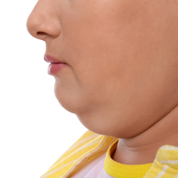 ساکشن غبغب!!نکاتی که احتمالا نمیدانستید... | دکتر امیرحسین بابائی جراح و متخصص گوش،حلق و بینی و جراح پلاستیک صورت | بهترین جراح پلاستیک صورت شیراز